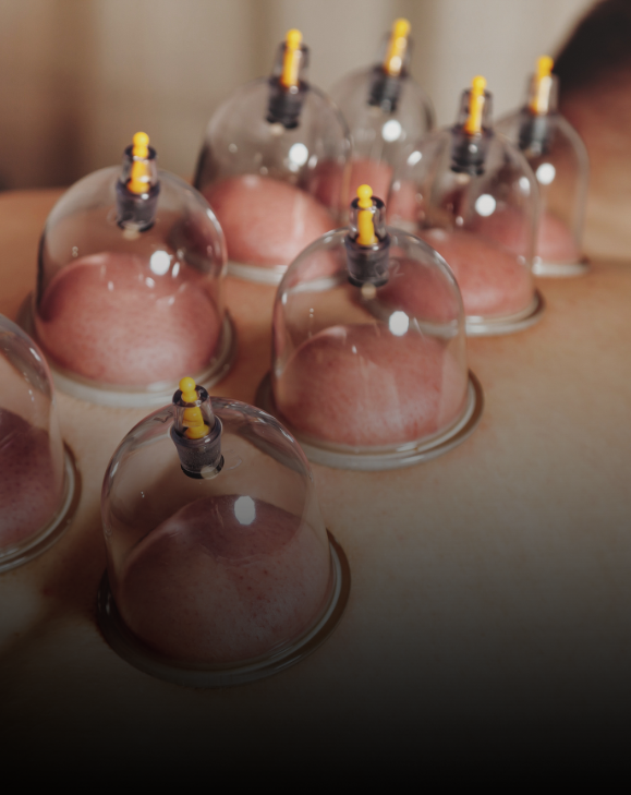 No More Fear of Cupping or Needles