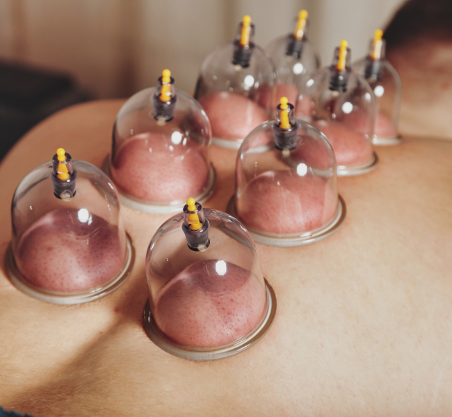 Dry Needling & Cupping Therapy